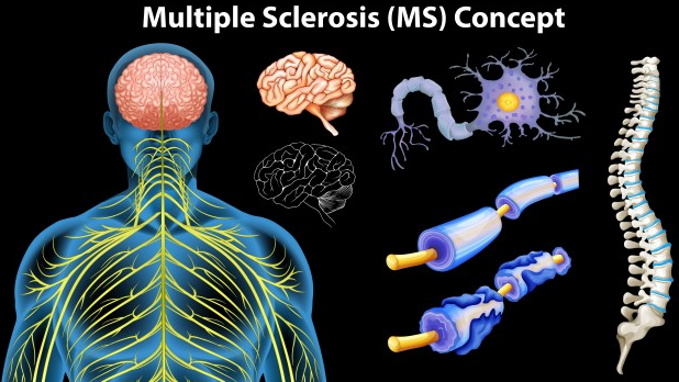 Tratamento de esclerose múltipla