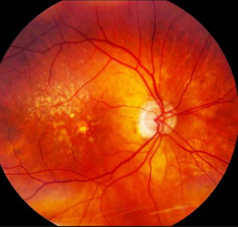 Degeneração macular: causas, sintomas e tratamentos naturais