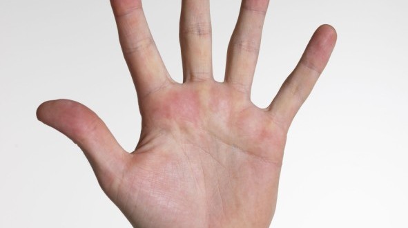 Esclerodermia: causas, sintomas e tratamentos naturais