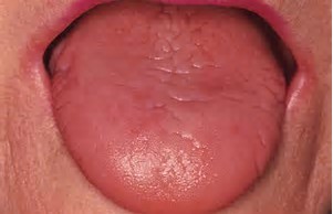 Síndrome de Sjögren: sintomas, causas e tratamentos naturais