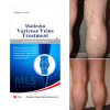 Creme para veias varicosas - Calmante para veias varicosas