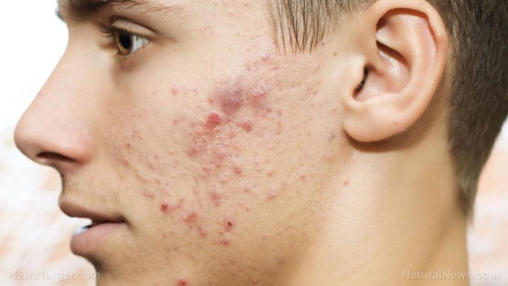 Acne: causas, efeitos colaterais e tratamentos