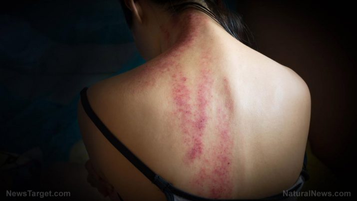 Activase: usos, riscos à saúde e efeitos colaterais