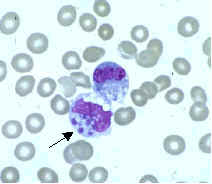 Erliquiose monocítica humana – causas, sintomas e tratamentos