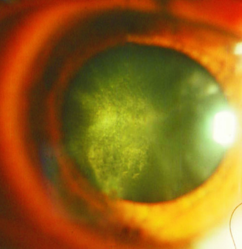 Onde posso ver fotos de antes e depois dos olhos tratados com Can‑C™?