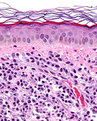 Mastocitose – causas, sintomas e tratamentos