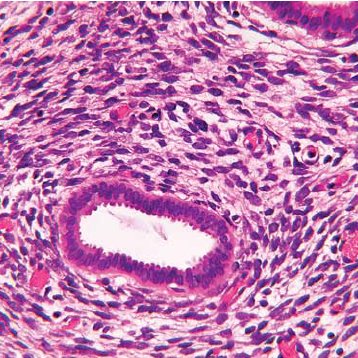 Sarcoma botryoides – causas, sintomas e tratamentos