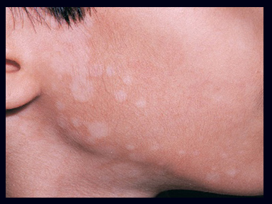 Vitiligo – causas, sintomas e tratamentos