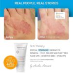 Creme DermaCalm SOS Therapy com 8% Ureia - Alívio para Eczema e Pele Seca em adultos e crianças - 2