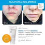 Creme DermaCalm SOS Therapy com 8% Ureia - Alívio para Eczema e Pele Seca em adultos e crianças - 4