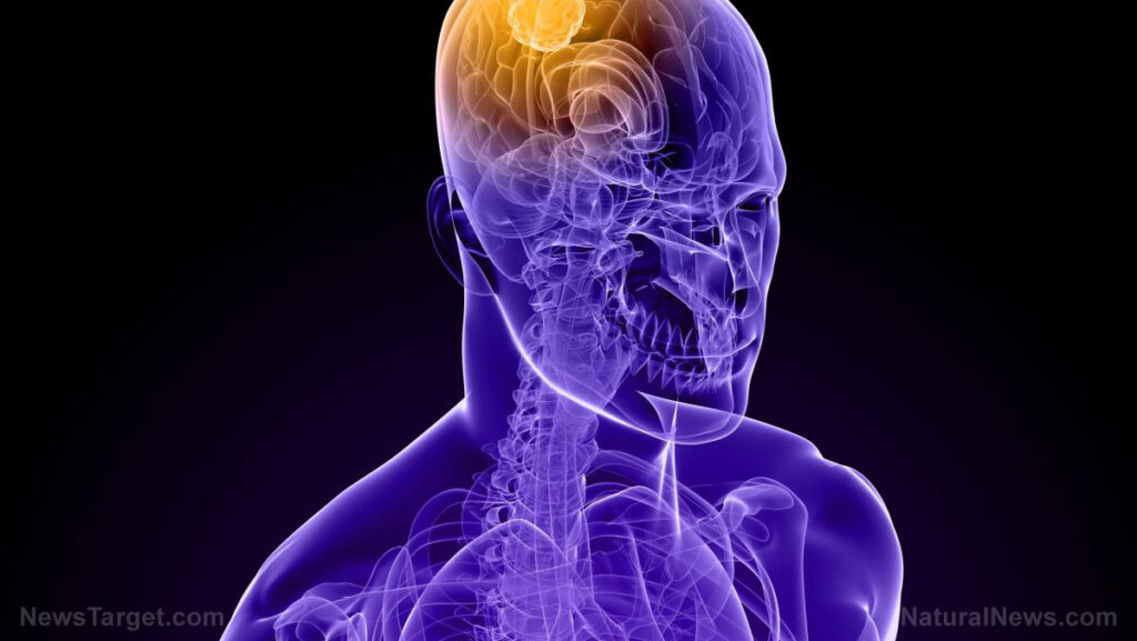 Descoberta revolucionária: Cientistas identificam origem do Alzheimer em células imunes inflamadas