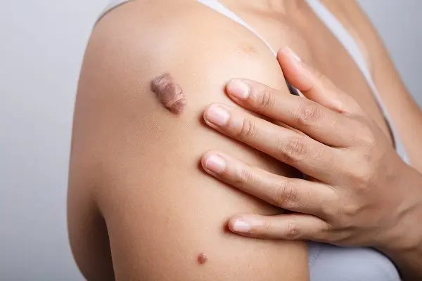 Tratamento Avançado de Queloides com Terapia Peptídica: Uma Nova Era