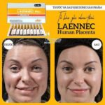 LAENNEC - Hidrolisado de Placenta Humana 2 ml por ampola - Pacote com 10 ampolas para Saúde e Beleza